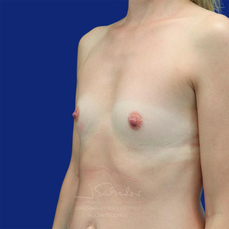 mamoplastia-caso7-ladoizq-antes