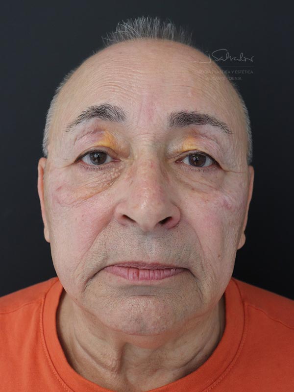 blefaroplastia-2-frente-antes
