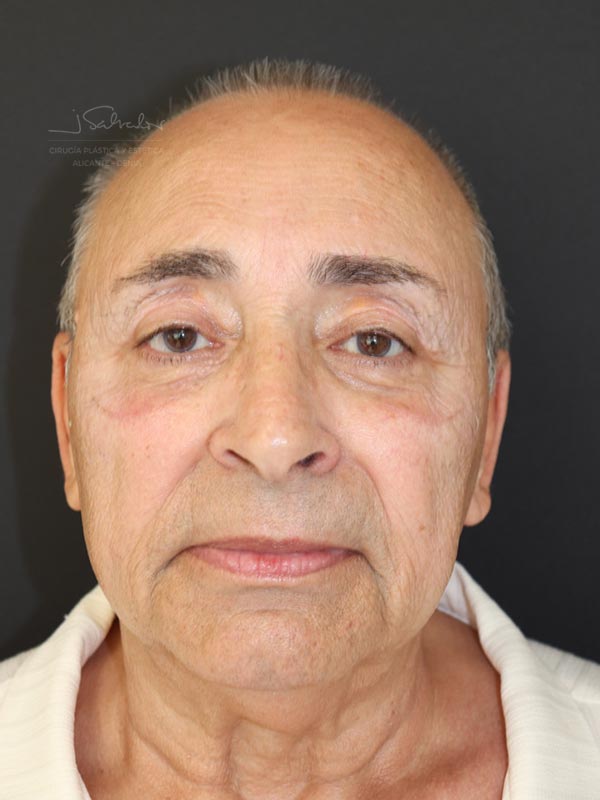 blefaroplastia-2-frente-despues