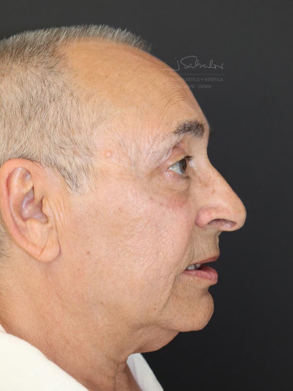 blefaroplastia-2-ladoder-despues