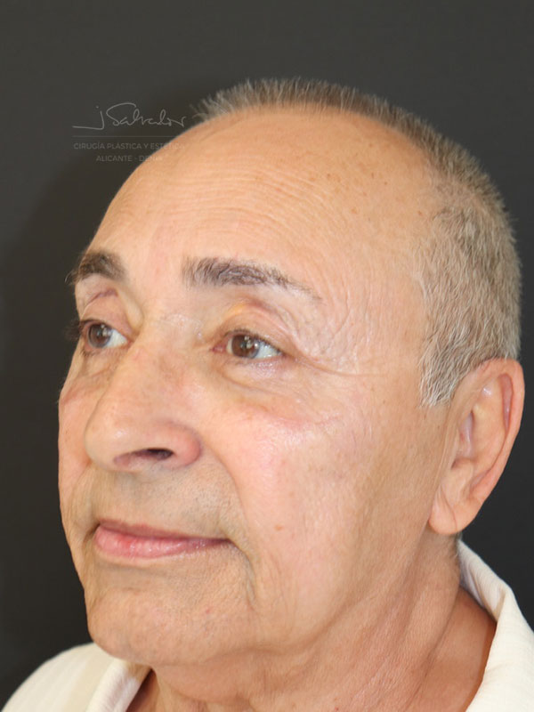 blefaroplastia-2-ladoizq-despues