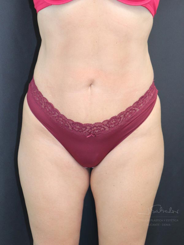 vaserlipo6-frente-4-despues