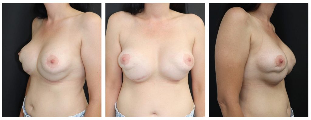 Imágenes de paciente con doble burbuja