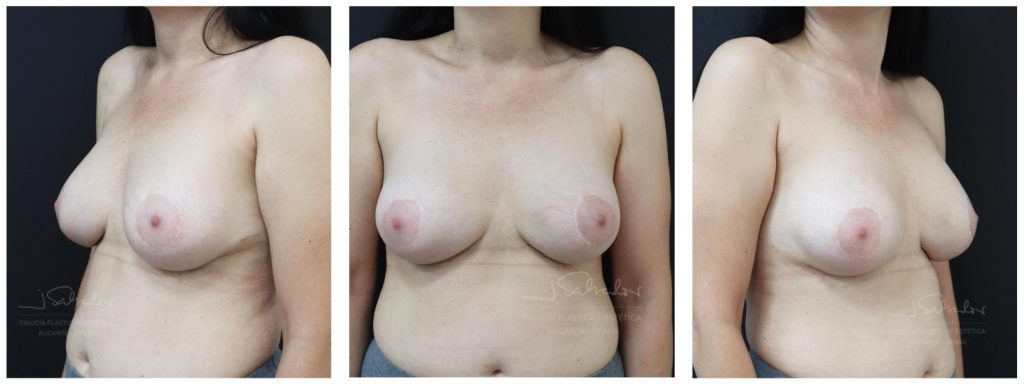 Imágenes de paciente con cirugía que soluciona la doble burbuja