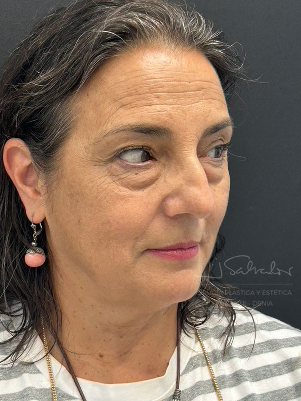 blefaro4-ladoder-antes.op_