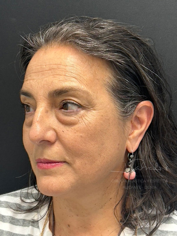 blefaro4-ladoizq-antes.op_