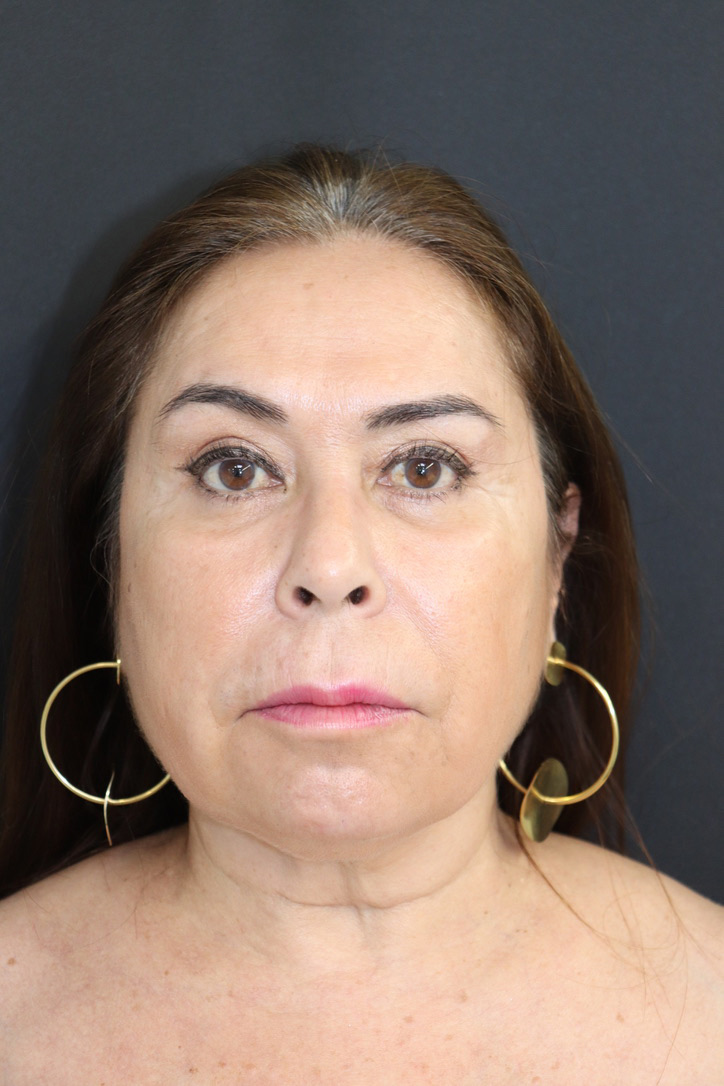 endolift-caso1-frente-antes-op2