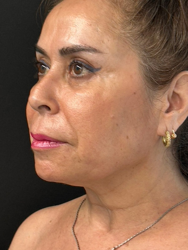 endolift-caso1-ladoizq-despues-op3