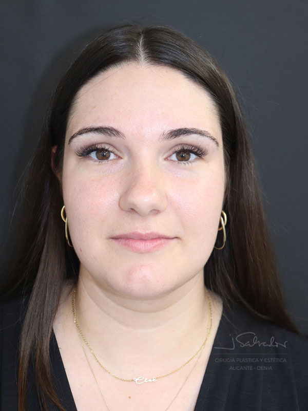 endolift-caso2-frente-antes