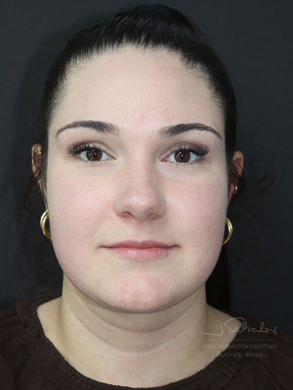 endolift-caso2-frente-despues