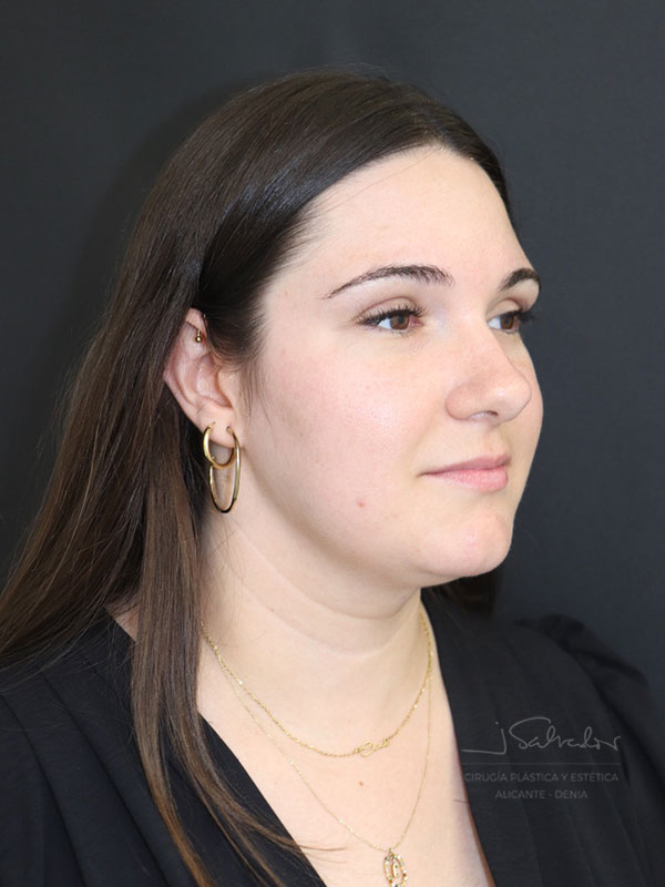 endolift-caso2-ladoder-antes