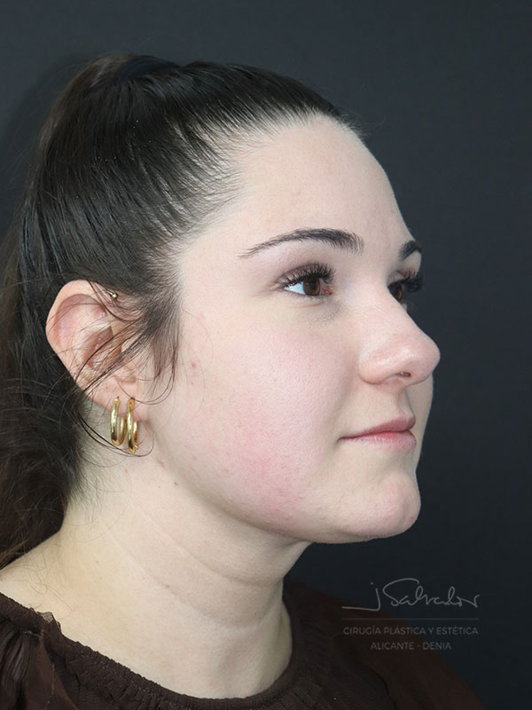 endolift-caso2-ladoder-despues