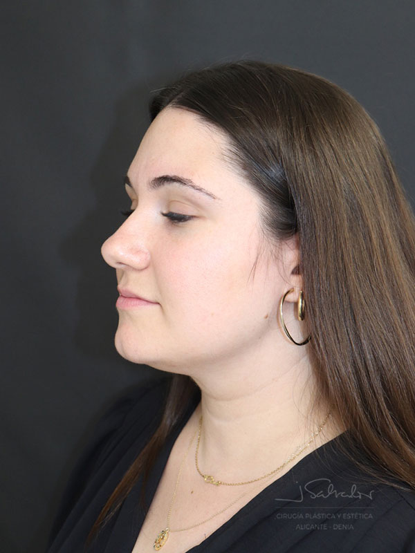 endolift-caso2-ladoizq-antes