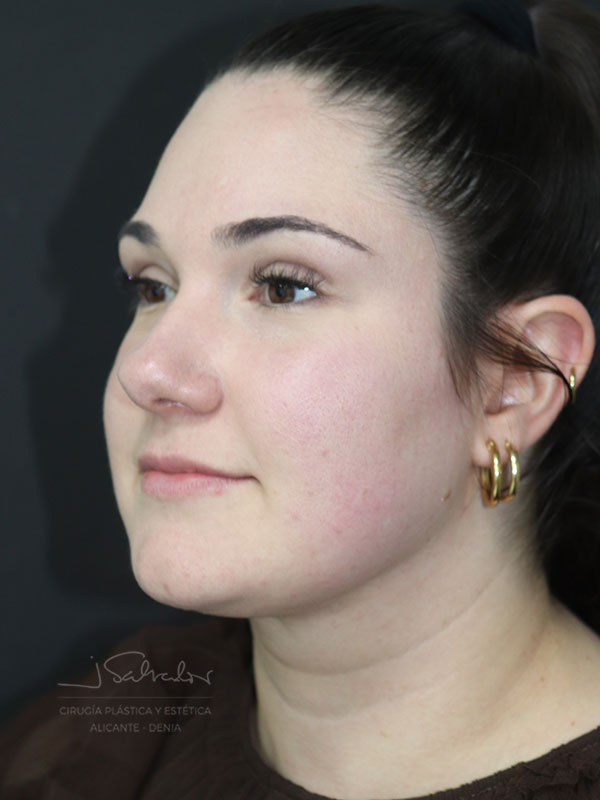 endolift-caso2-ladoizq-despues