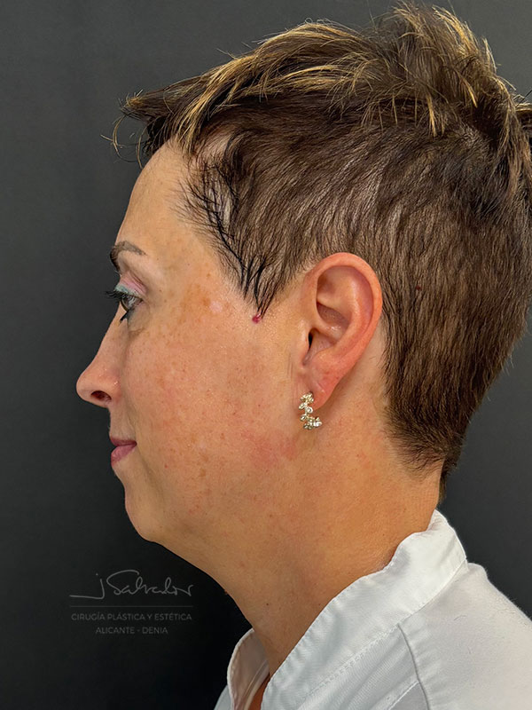 endolift-caso3-izq-antes