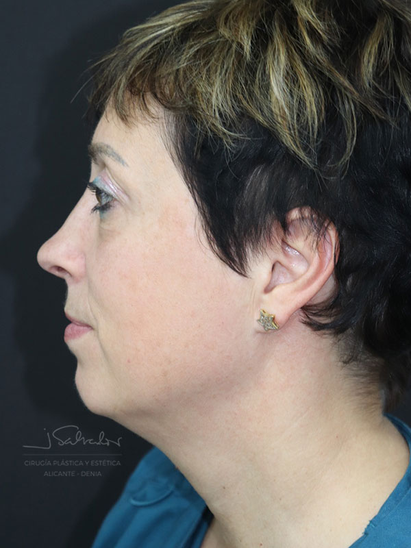 endolift-caso3-izq-despues