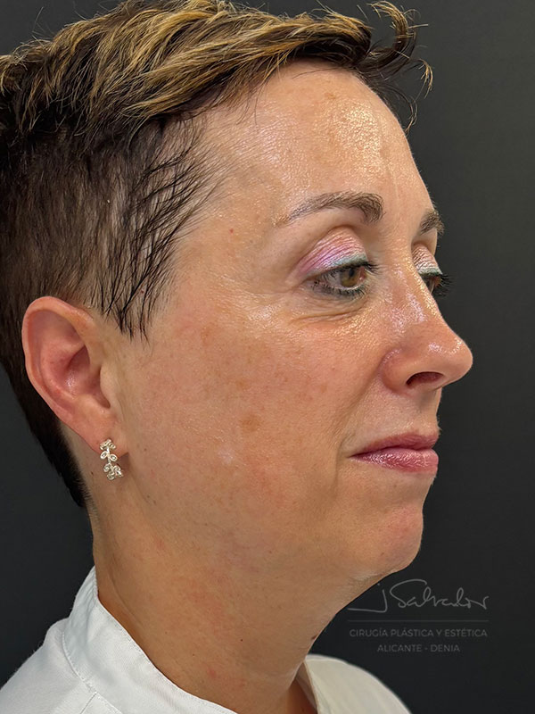 endolift-caso3-ladoder-antes