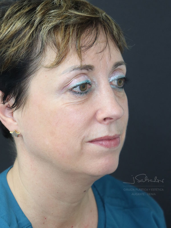 endolift-caso3-ladoder-despues