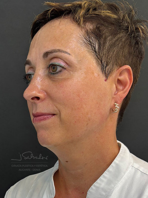 endolift-caso3-ladoizq-antes