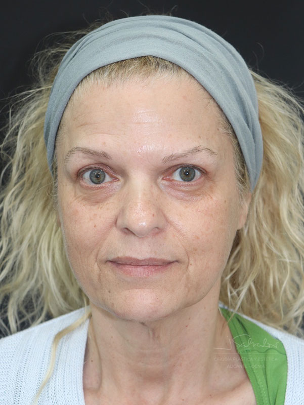 endolift-caso4-frente-antes endolift-caso4-frente-antes