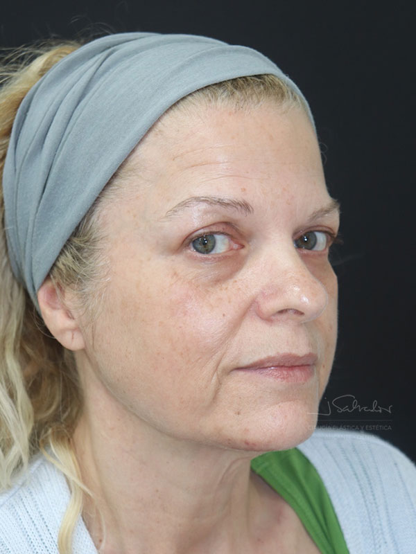 endolift-caso4-ladoder-antes endolift-caso4-ladoder-antes