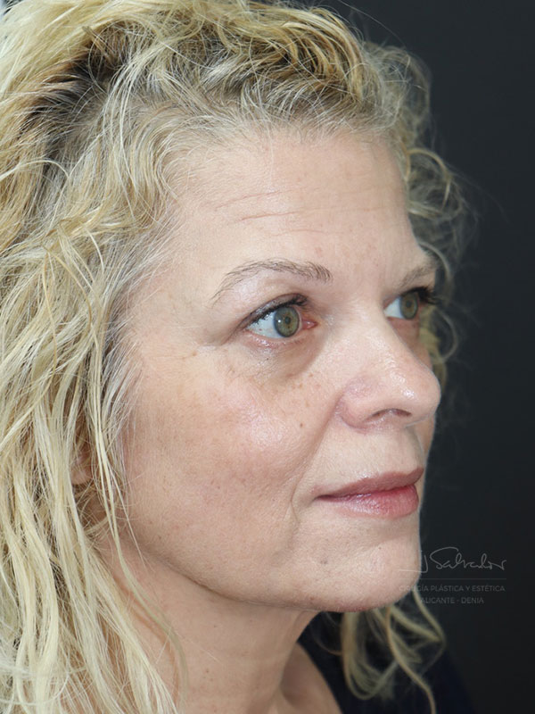 endolift-caso4-ladoder-despues endolift-caso4-ladoder-despues
