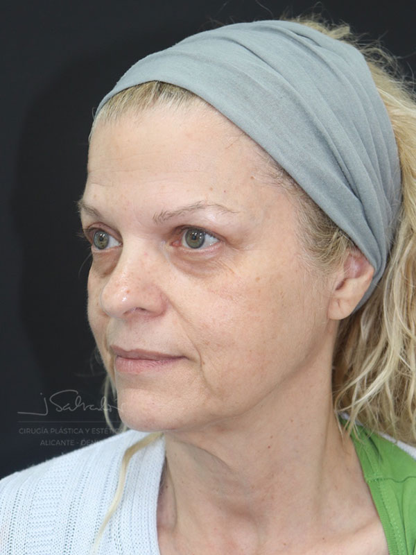 endolift-caso4-ladoizq-antes endolift-caso4-ladoizq-antes