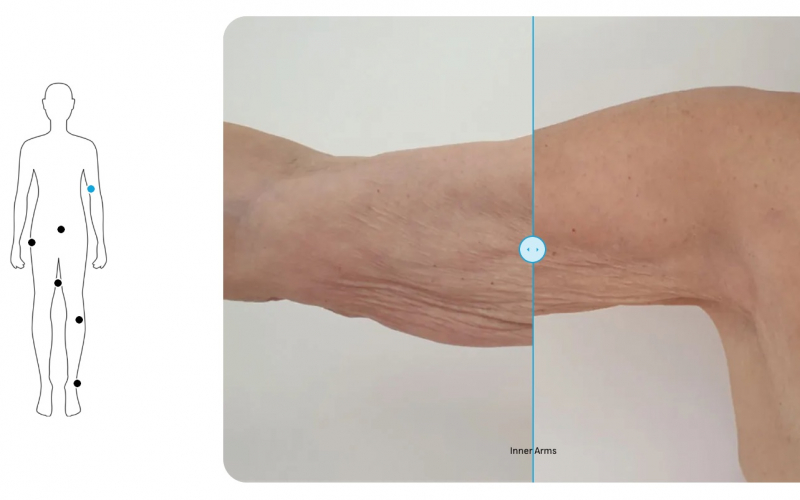 results-endolift-brazo