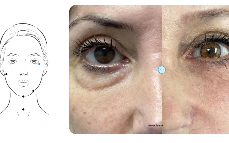 results-endolift-cara